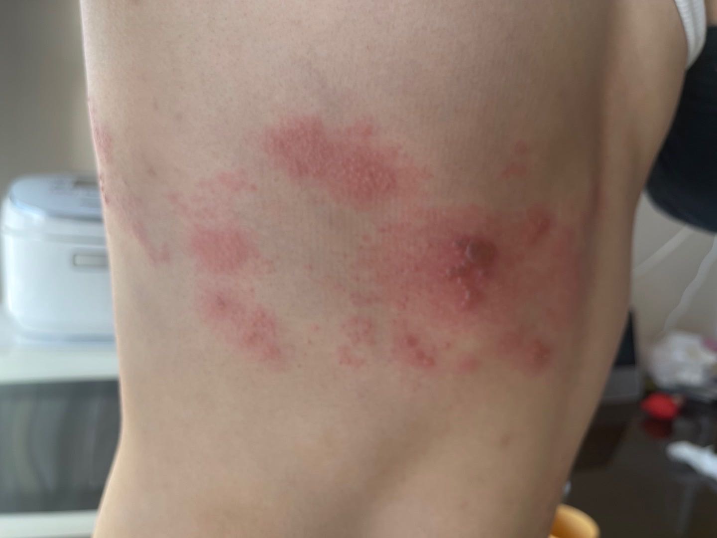 感觉辉瑞疫苗副作用在我身上有点大[惊恐]